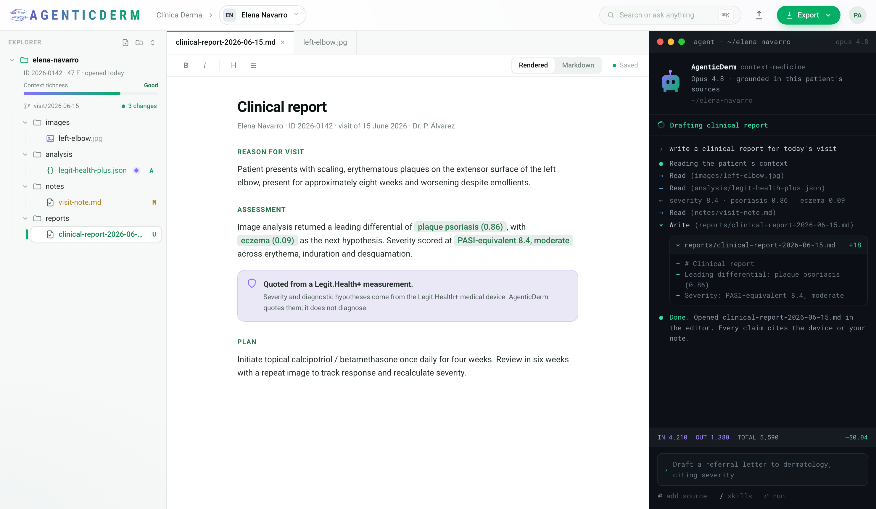The AgenticDerm workspace: the patient's sources and source-control status on the left, a clinical report being edited in the centre, and the agent drafting work on the right.