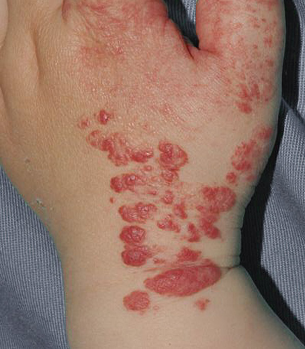 A vascular lesion on the back of a hand