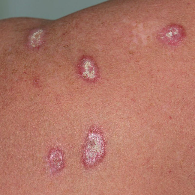 An autoimmune rash on a shoulder