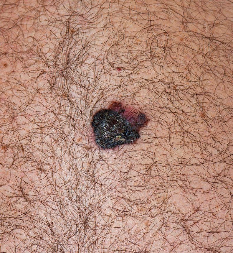 A pigmented lesion on the back